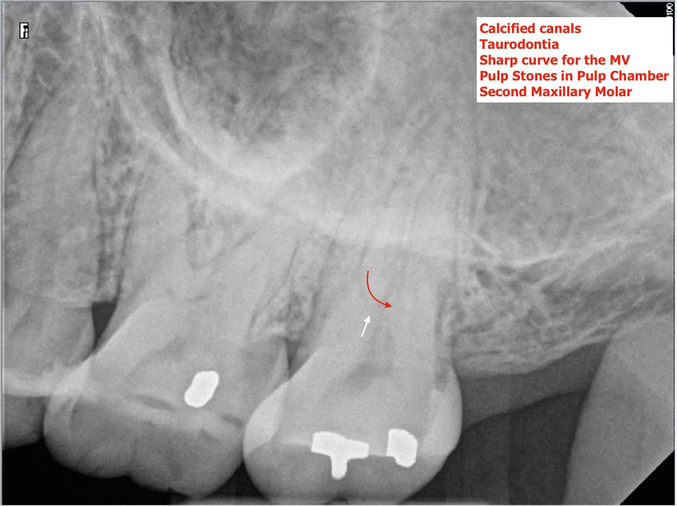 Root canal treatment procedure on 27 taurodontia and calcified A 2016-06-07