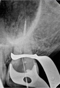 Root canal treatment procedure on 27 taurodontia and calcified B 2016-06-07