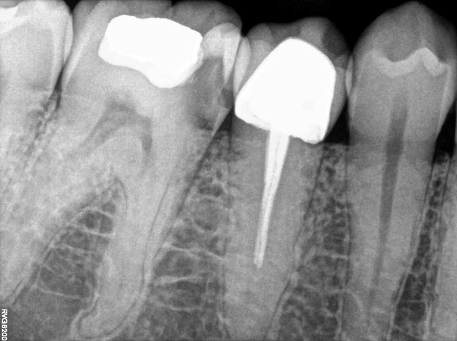 47 Root Canal Treatment on a Calcified molar A