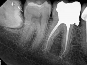 47 Root Canal Treatment on a Calcified molar B