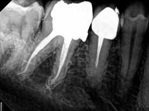 47 Root Canal Treatment on a Calcified molar C