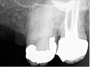 Calcified, curved and long canals  26A pre therapy
