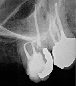 calcified-curved-and-long-canals-26c-2016-12-03 Post therapy B