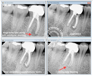 selective root canal retreatment 