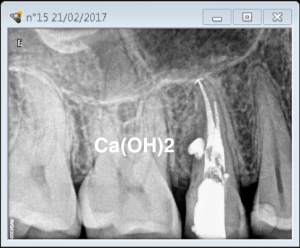 Root canal revision procedure on tooth 15 lateral canal management B
