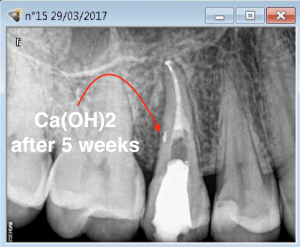 Root canal revision procedure on tooth 15 lateral canal management C