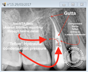 Root canal revision procedure on tooth 15 lateral canal management D