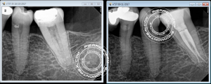root canal treatment on a C shape root canal system
