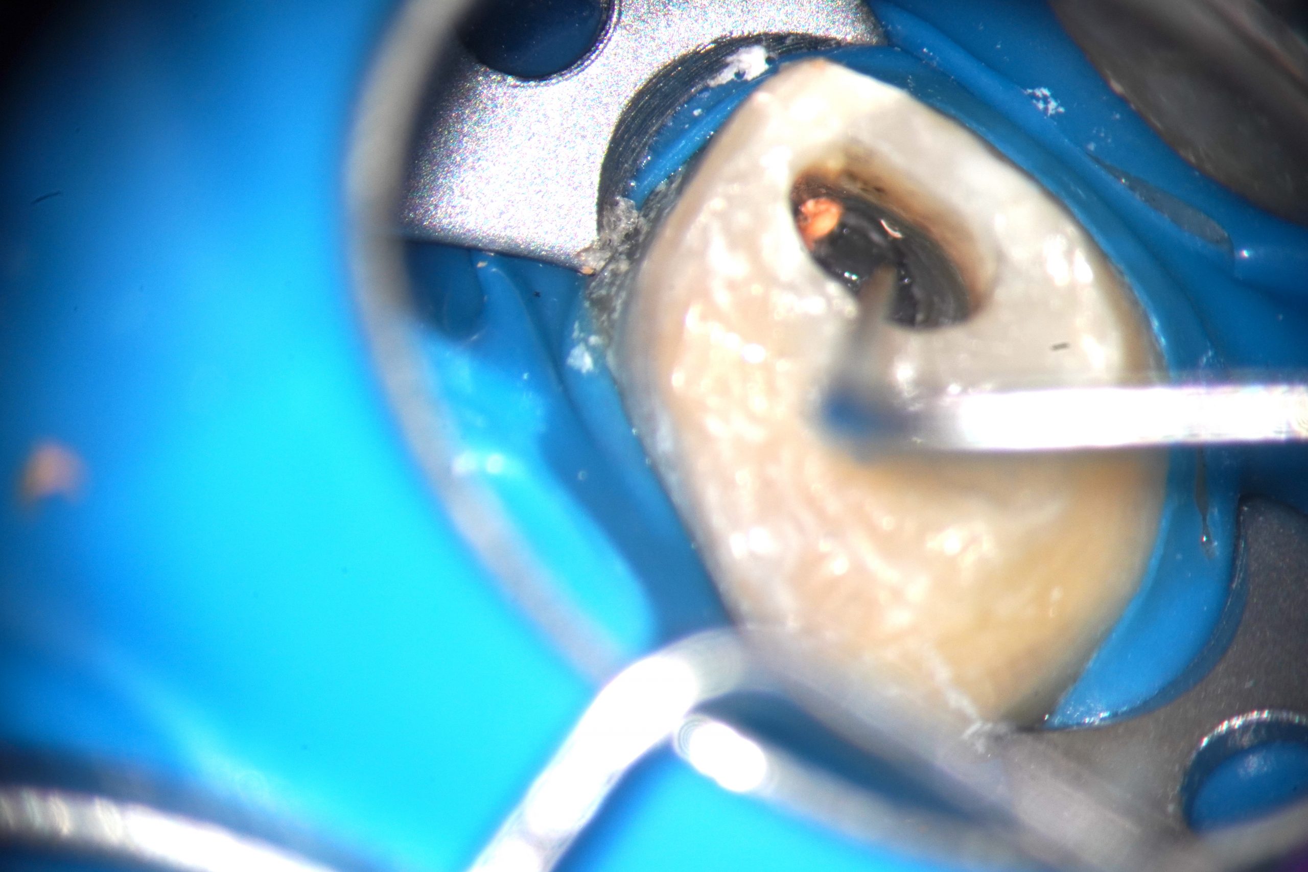 Tooth saving with Elective Root Canal Revision ENDOMONTREAL