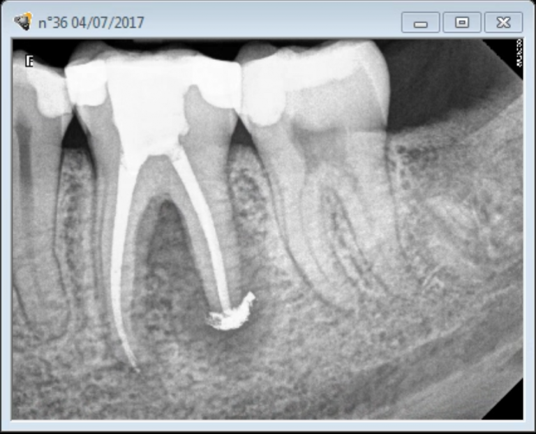 Saving a Severely Calcified Tooth with a Root Canal Procedure