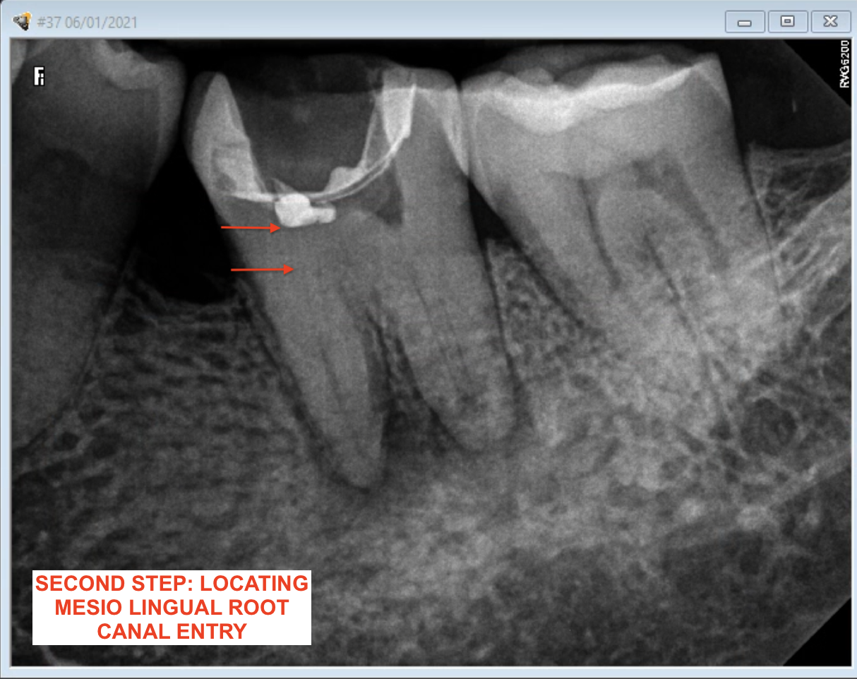 Root Canal Calcifications, a Challenge in Root Canal Treatments ENDOMONTREAL