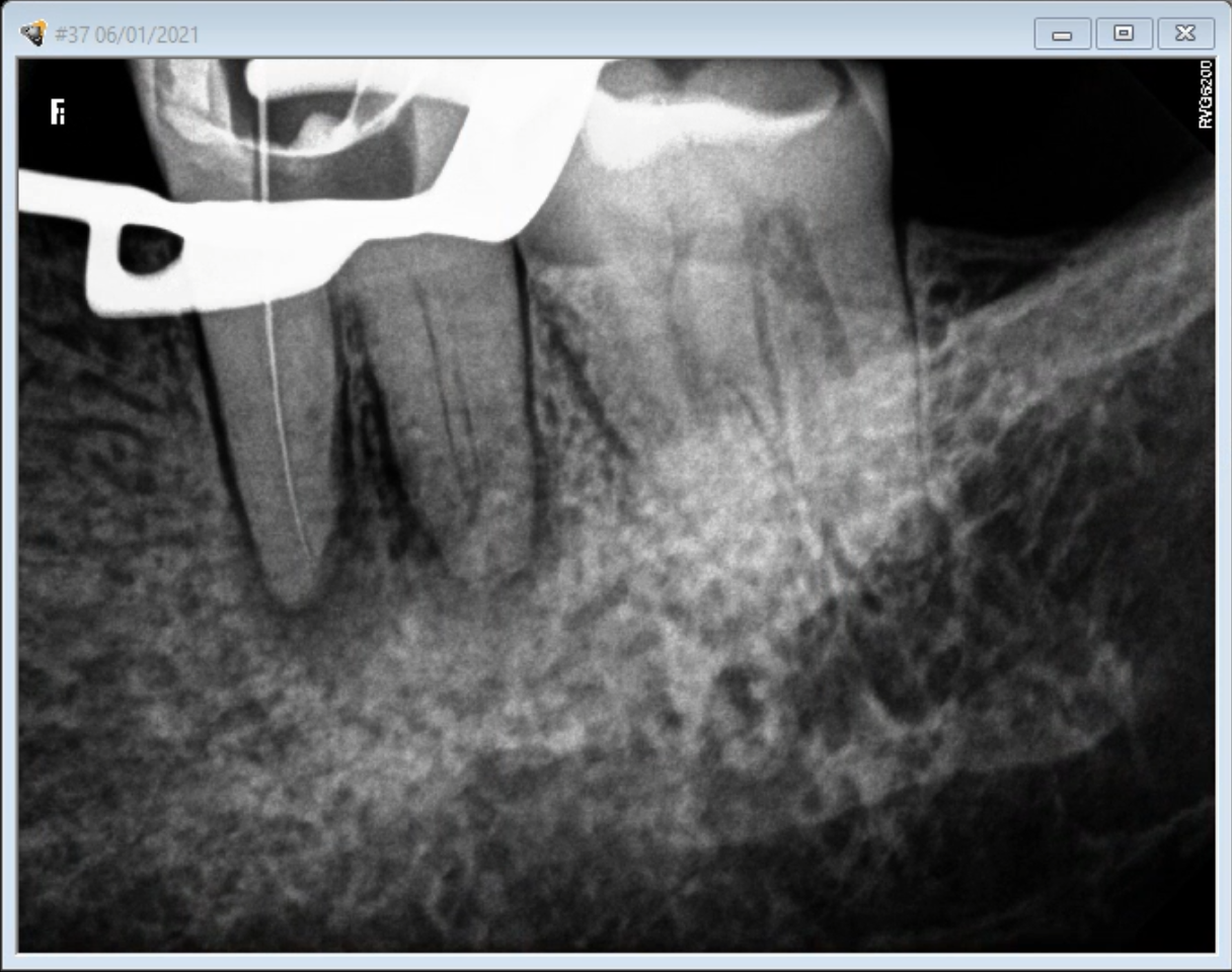 Root Canal Calcifications, a Challenge in Root Canal Treatments ENDOMONTREAL