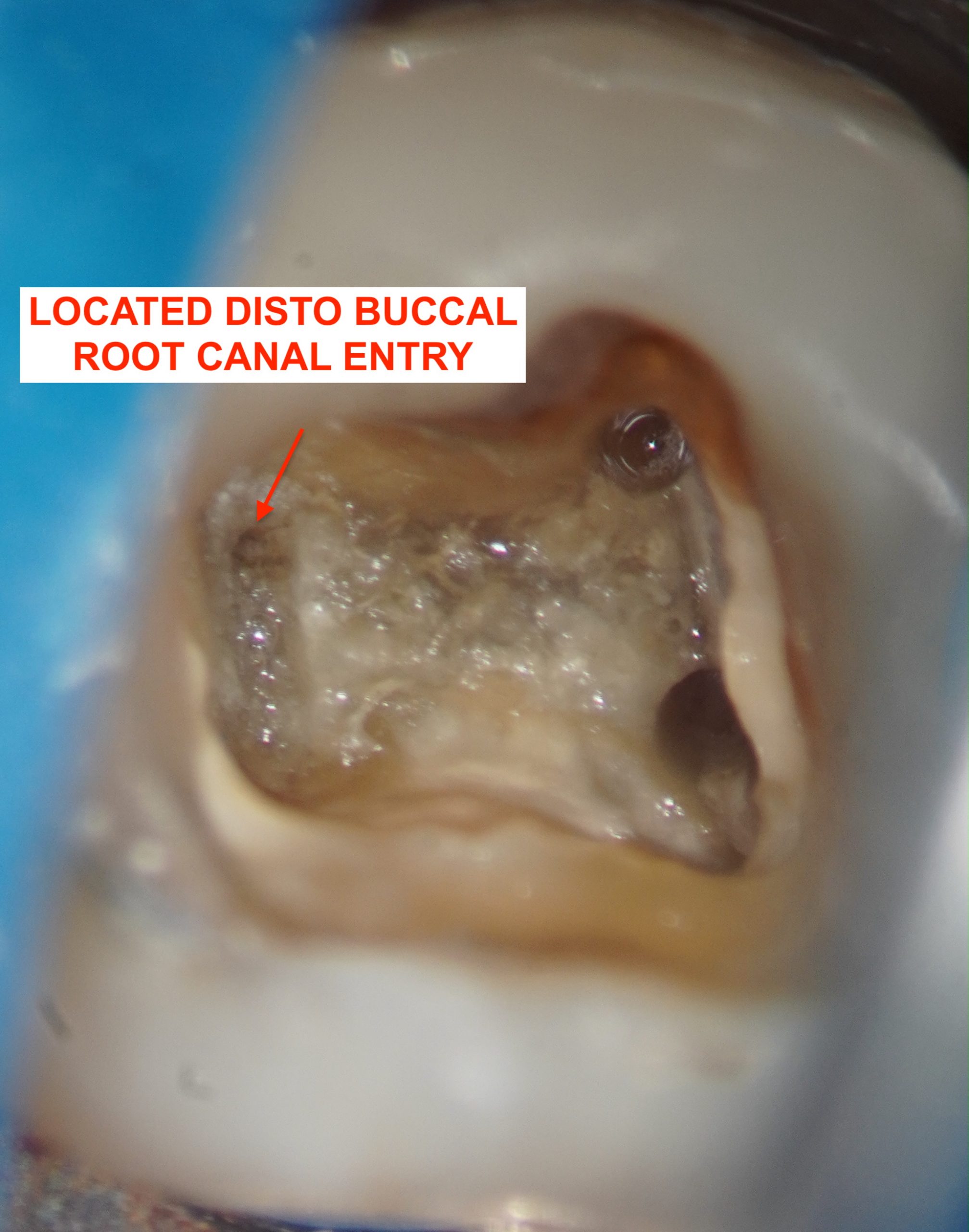 Root Canal Calcifications, a Challenge in Root Canal Treatments