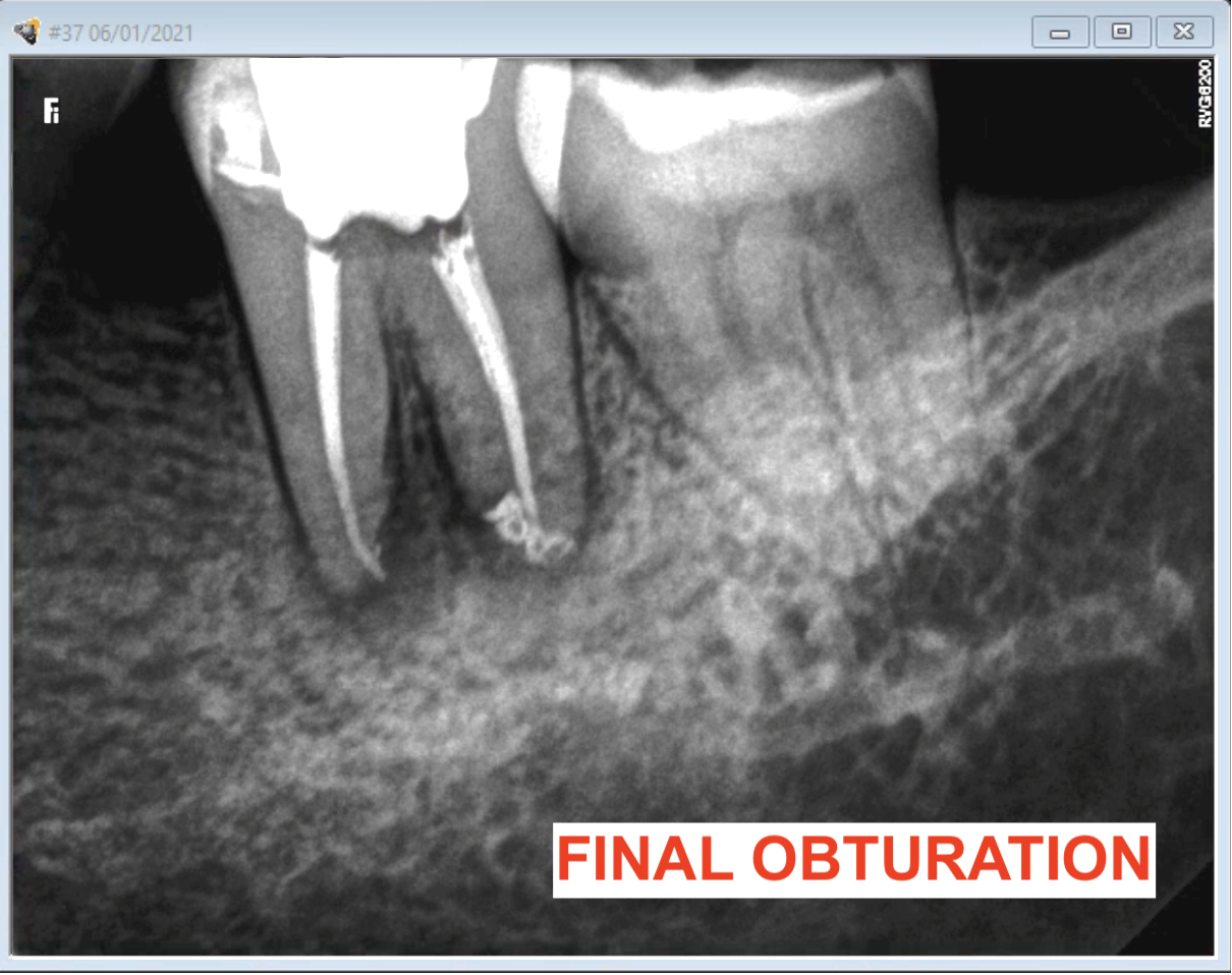 Root Canal Calcifications, a Challenge in Root Canal Treatments ENDOMONTREAL